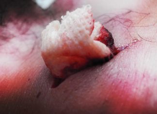 How to Treat a Knife or Stab Wound When You Can’t Call 911