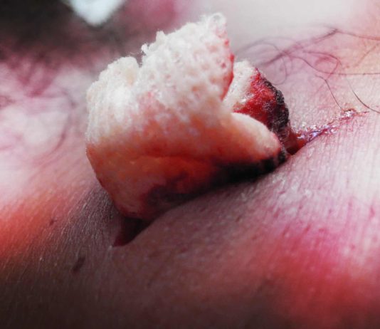 How to Treat a Knife or Stab Wound When You Can’t Call 911