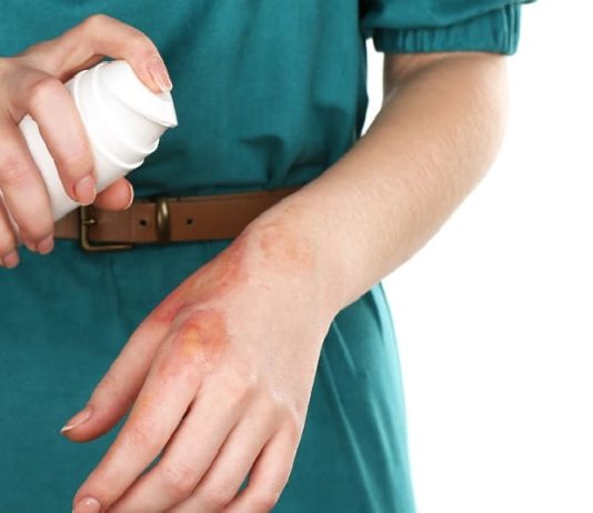 First Aid For Burns – Kit and Contents List