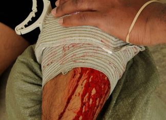 How to Treat and Pack a Bullet Wound in the Wilderness