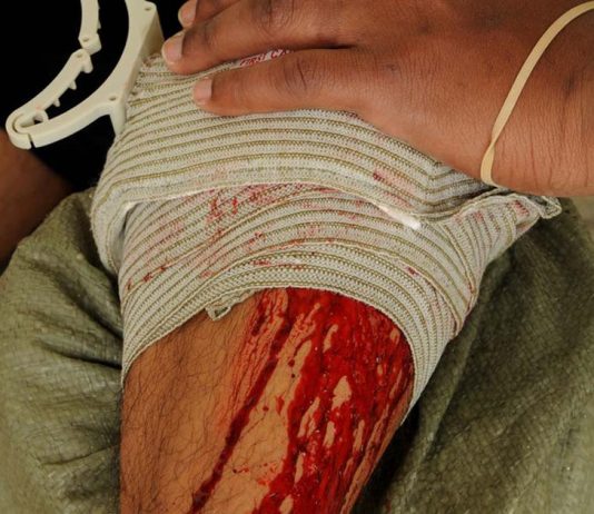 How to Treat and Pack a Bullet Wound in the Wilderness
